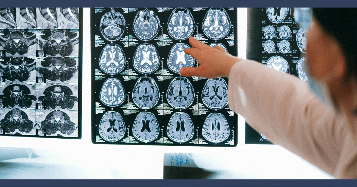 Doctor pointing at a brain scan